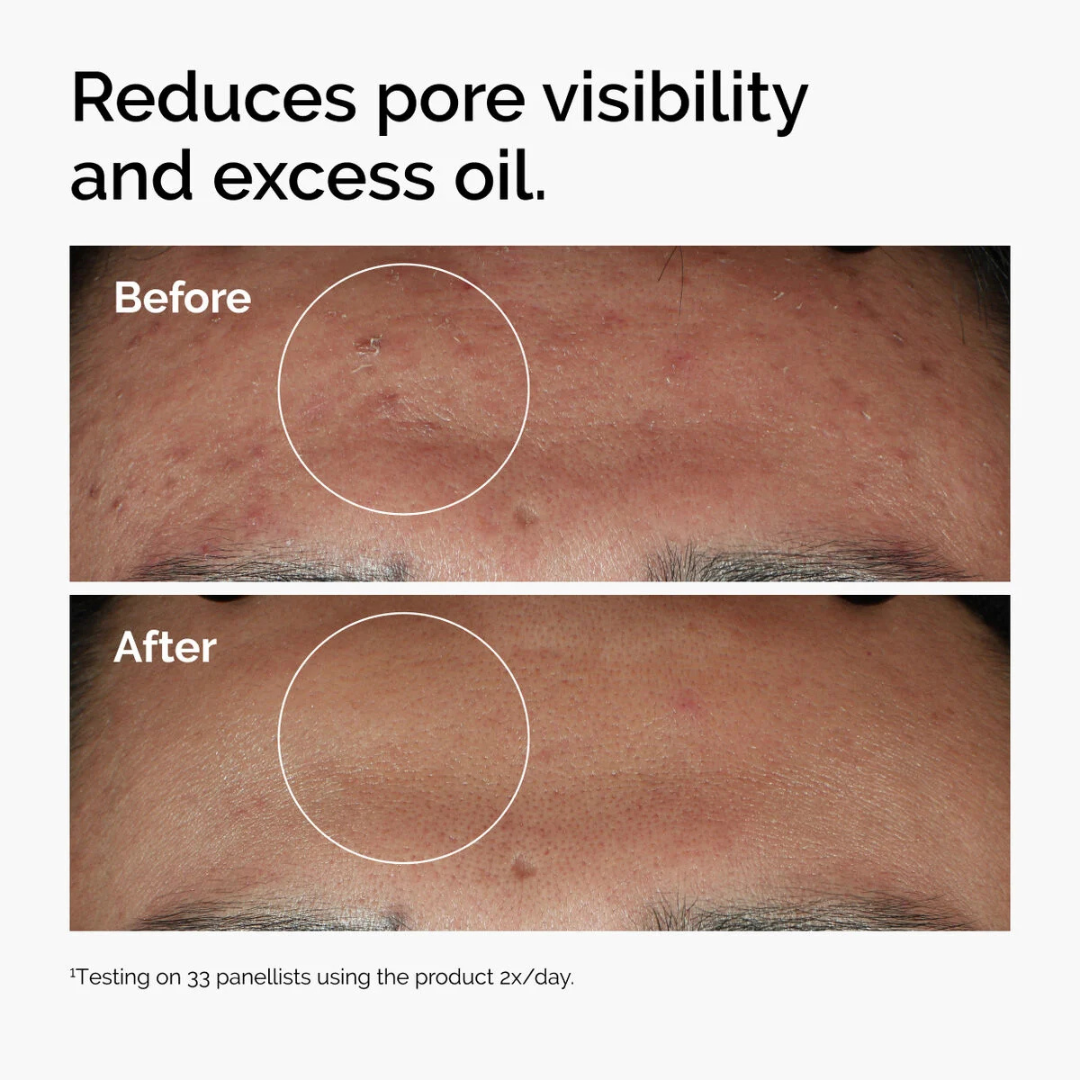 OD- Niacinamide 10% + Zinc 1% - 30 ml - FOR BLEMISHES